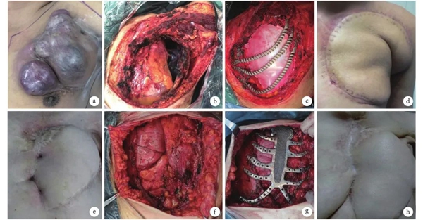 a:粘液纤维肉瘤,侵犯左侧 1～4 肋骨;b:切除肿瘤后的胸壁缺损;c
