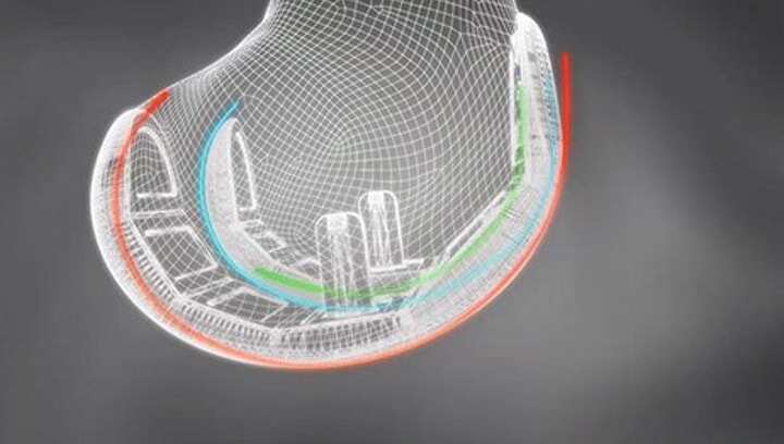 英國完成首例3D打印人造膝蓋植入手術