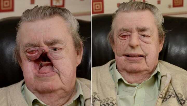 3D打印假體面部讓皮膚癌幸存者重獲新生