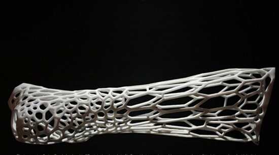 3D打印給骨折患者帶來新福音