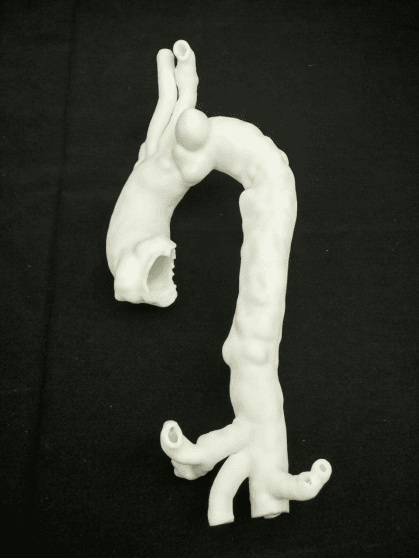 【案列】3D打印主動脈弓部輔助手術(shù)治療