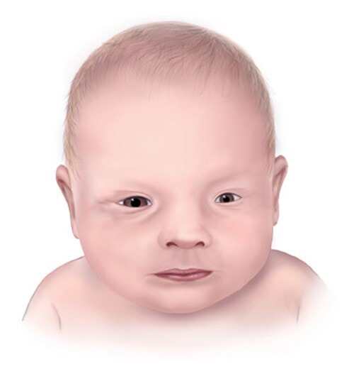 3D打印眼睛假體幫助眼疾患兒