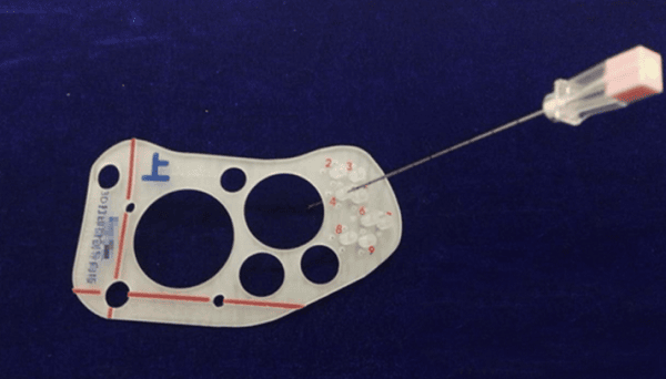 3D打印粒子植入治療腫瘤