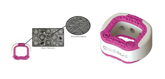 Osseus 3D打印頸椎植入物獲得FDA 批準(zhǔn)