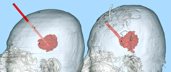 3D打印技术精准穿刺治疗脑出血