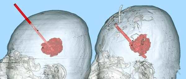 3D打印技術(shù)精準(zhǔn)穿刺治療腦出血