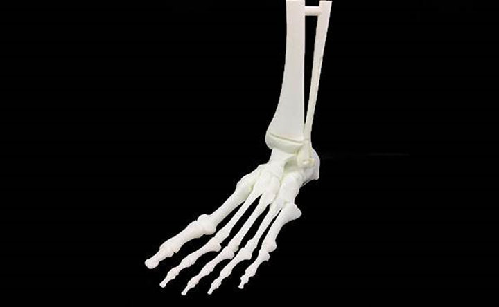 3D打印助力双侧胫骨远端骨折及踝关节粉碎性骨折术