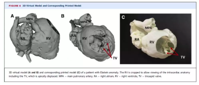 解析：3D打印技术在心衰疾病的应用方向