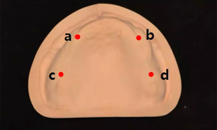 与磨制和注射成型假牙相比，3D打印假牙如何叠加？