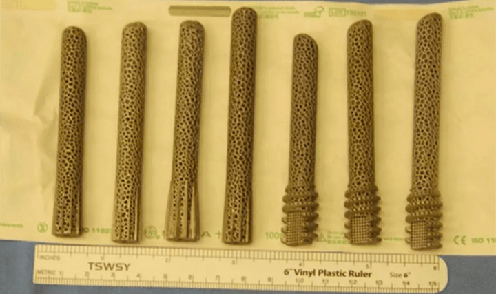 全球首例！“3D打印+仿生”鉭金屬多孔股骨頭支架植入人體