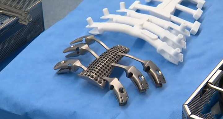 案例！澳大利亞卡車司機成功完成胸骨3D打印鈦植入物替換術(shù)