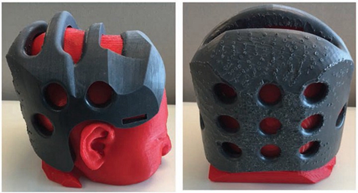 案例！3D打印矫形头盔保护术前骨病头颅