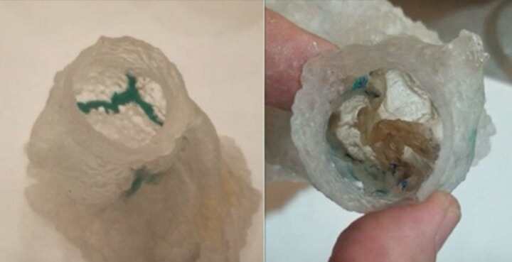 案例！外科醫(yī)生利用3D打印技術進行術前模擬