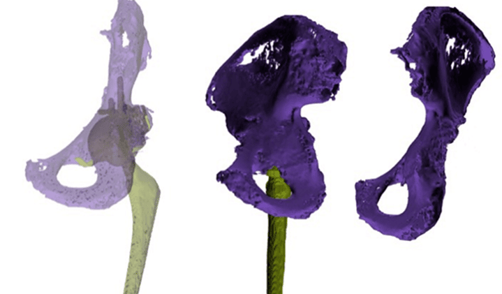 3D建模和3D打印可以改善THA診斷、分類和手術(shù)計(jì)劃