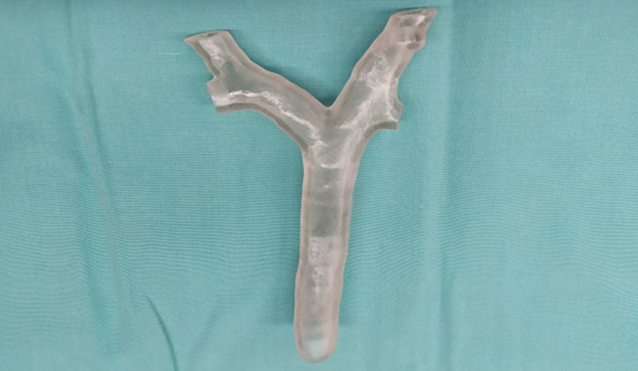 应用！3D打印辅助以色列7岁女孩完成肺部手术