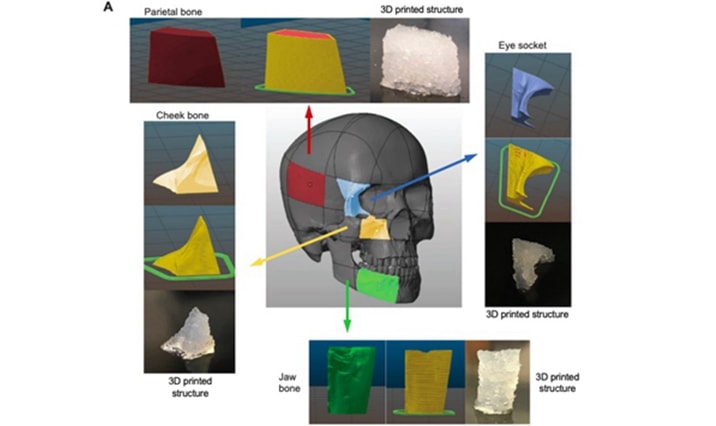 德州農(nóng)工大學研究人員使用生物3D打印材料制作面部骨移植物