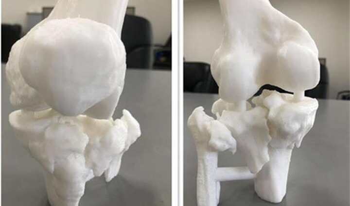 案例！協(xié)和江南醫(yī)院利用3D打印技術(shù)，成功為骨折患者實施手術(shù)