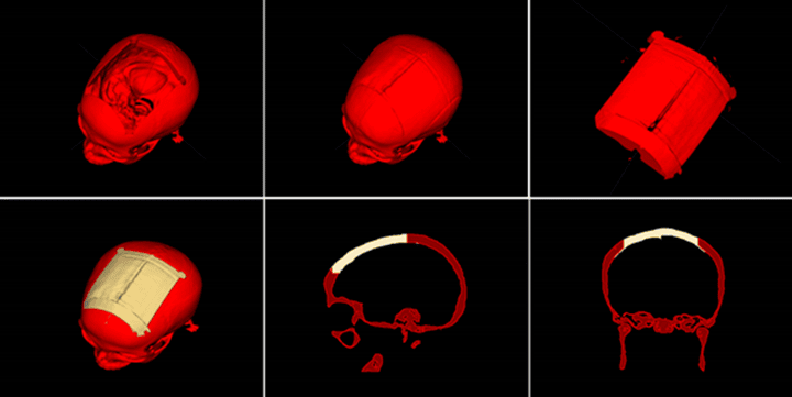 研究人員發(fā)布免費(fèi)的自動(dòng)化設(shè)計(jì)軟件以生產(chǎn)3D打印顱骨植入物