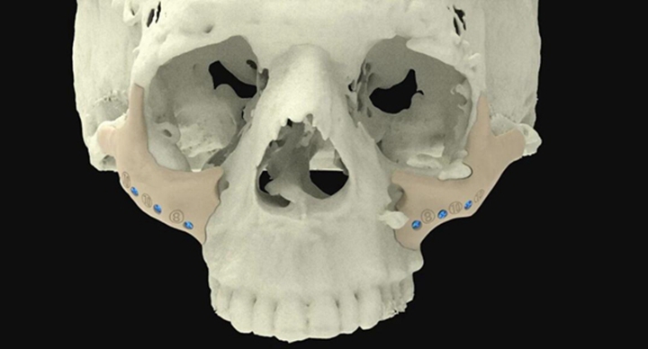 用于重建人体骨骼的3D打印技术