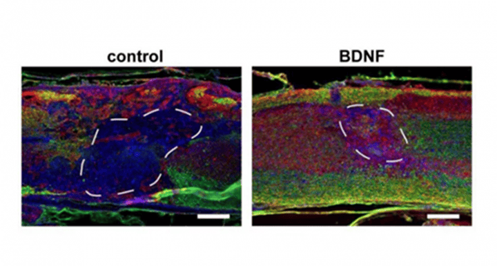 科學(xué)家開發(fā)注射式支架材料 或有助于修復(fù)脊柱損傷后的神經(jīng)