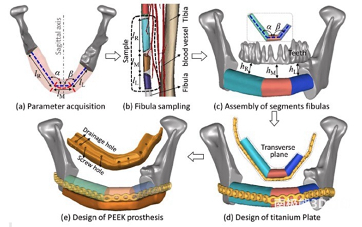 3D打印的PEEK植入物修复下颌骨缺损-一种新方法