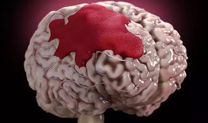 3D打印导板导航下的脑出血治疗新篇章