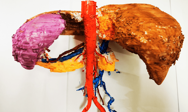 3D打印助力精准外科，利用3D打印技术指导胃癌根治手术