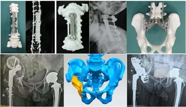 全國(guó)首例3D打印定制鋼板成功植入！從“風(fēng)口”到“風(fēng)向”，骨科企業(yè)爭(zhēng)相入局