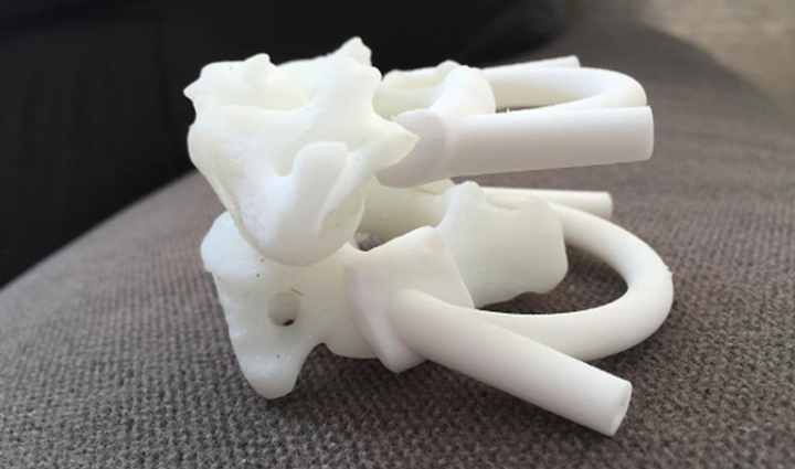 颈椎里长肿瘤 3D打印助力精准切除