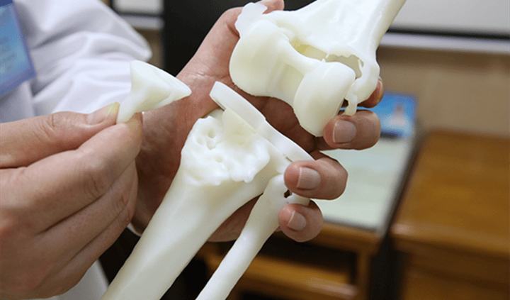 3D打印會否取代繃帶石膏？