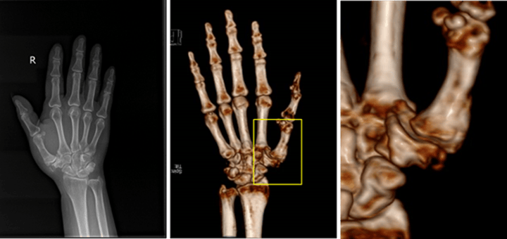 3D打印多孔鉭金屬掌指關(guān)節(jié)置換成功實(shí)施