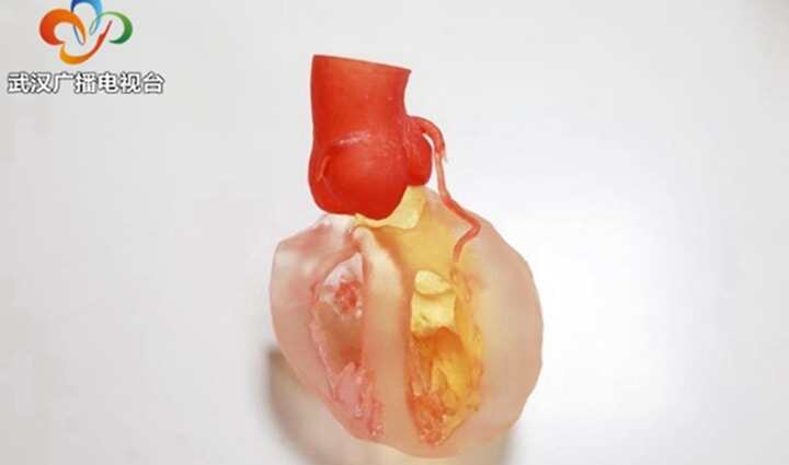 3D打印“加持” ，17歲少年精準(zhǔn)實(shí)施二次心臟手術(shù)