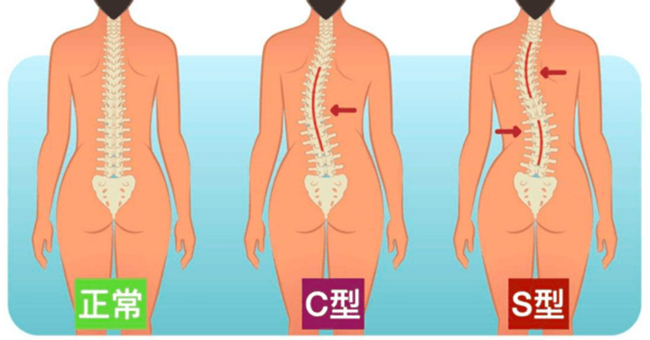 關(guān)于3D打印脊柱側(cè)彎矯形器，你不知道的事