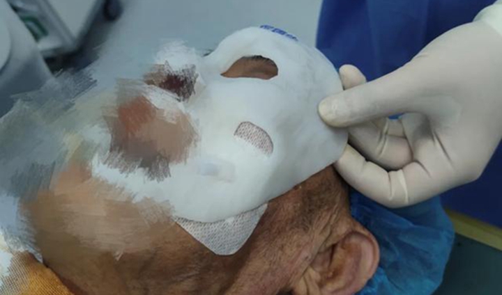 百岁老人三叉神经痛5年多，3D打印辅助微创球囊压迫让他不开颅解除面部疼痛难题