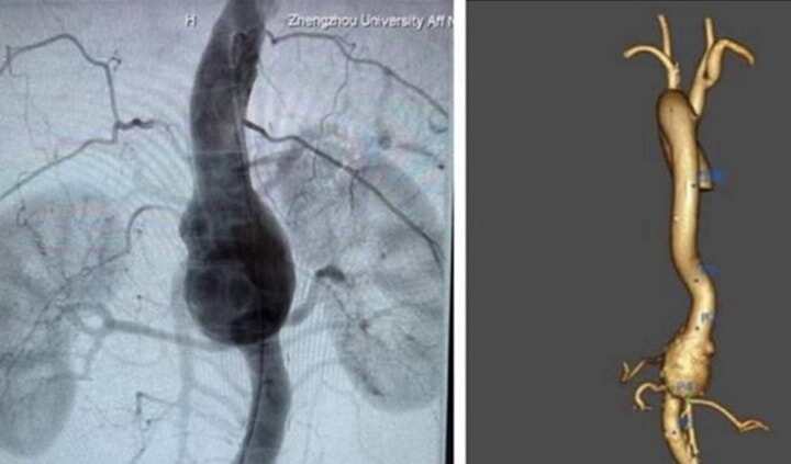 “3D打印”技術助力治療高難度主動脈瘤