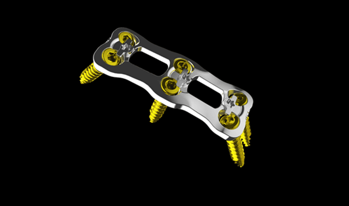 3D打印鈦合金頸椎前路固定板獲得FDA許可