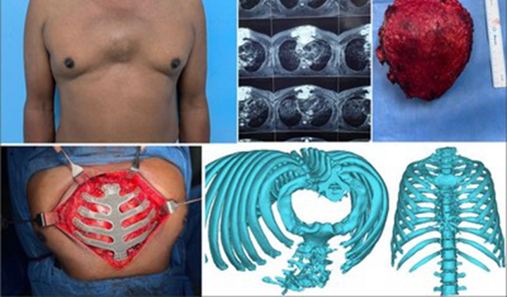 印度医院3D打印钛合金胸骨植入物，拯救了癌症患者的生命