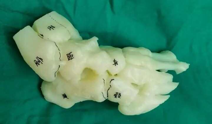 邯鄲市第一醫(yī)院3D打印技術(shù)指導(dǎo)馬蹄內(nèi)翻高弓足截骨矯形四關(guān)節(jié)融合術(shù)