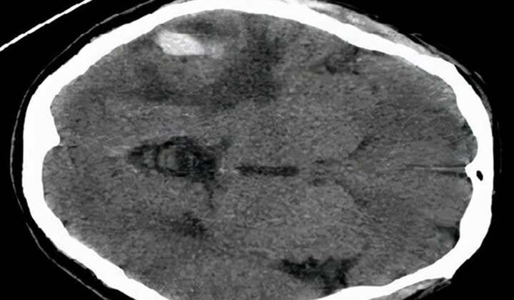 陜西省核工業(yè)二一五醫(yī)院：3D打印再立新功，精準(zhǔn)定位輔助切瘤