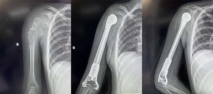 13歲少女患骨肉瘤面臨截肢，3D打印肱骨假體治療成功保肢
