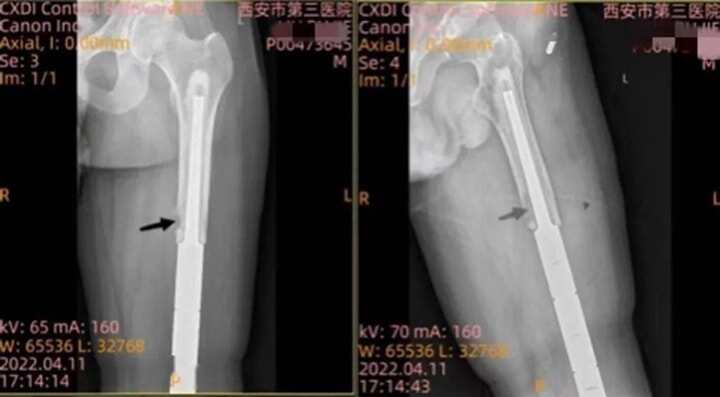國內首例3D打印“瓦片”保住肢體 做別人不敢想的事