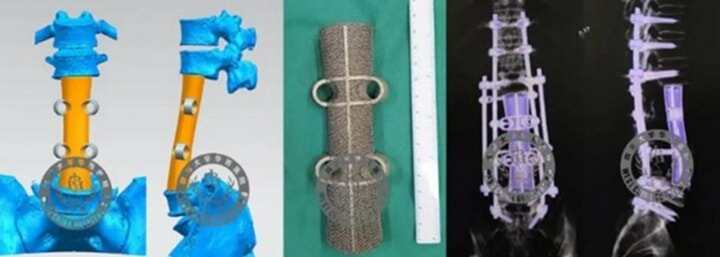 四川大學(xué)華西醫(yī)院用3D打印假體成功重建被整塊切除的腰椎骨