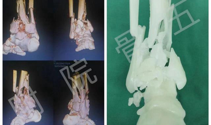 3D打印技术助力河北工程大学附属医院完成骨科手术