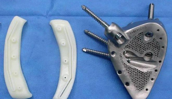 3D打印技术赋能！烟台山医院为骨盆肿瘤患者定制“钢筋铁骨” - 图片
