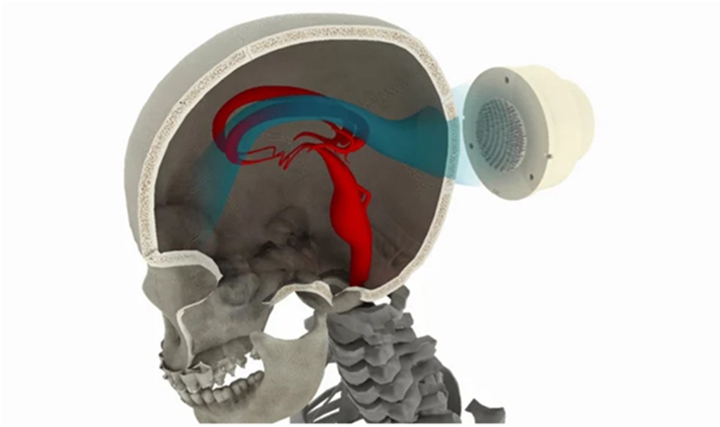 大脑的“全息投影”，研究人员利用3D打印超声全息图治疗神经系统疾病 - 图片