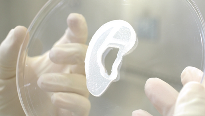 国际上首例自体细胞培养的3D打印耳朵完成移植