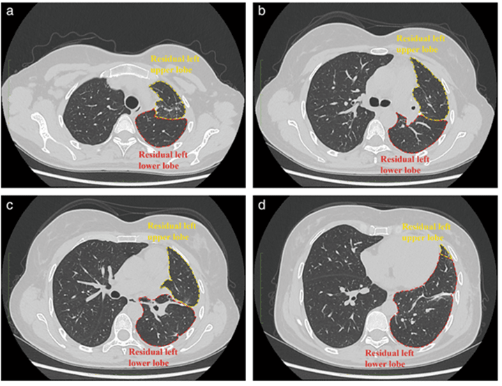手術(shù)中使用3D打印肺模型，快速定位肺結(jié)節(jié)！