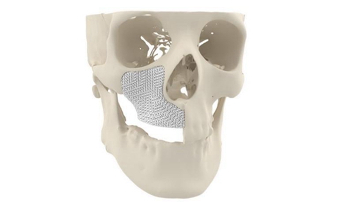 3D打印的MYBONE颌面移植物在欧洲获批供患者使用