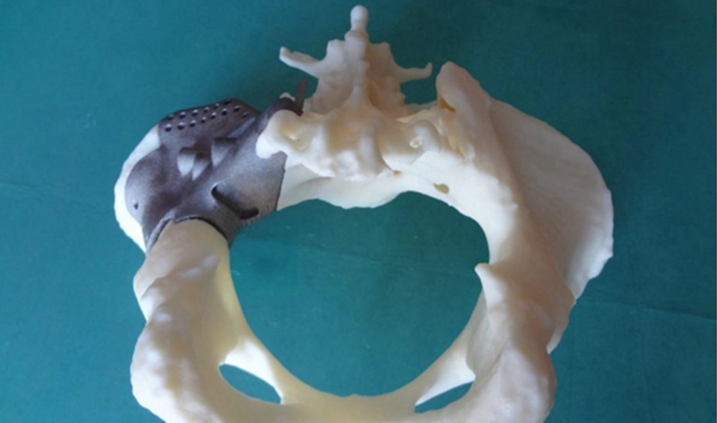 Onkos Surgical 3D打印骨盆获得FDA批准，已允许用于临床重建治疗