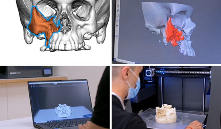 3D打印技术成功助力切除患者眼部肿瘤